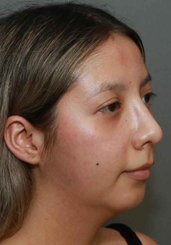 Aesthetic Rhinoplasty Before & After Gallery - Patient 37536322 - Image 4