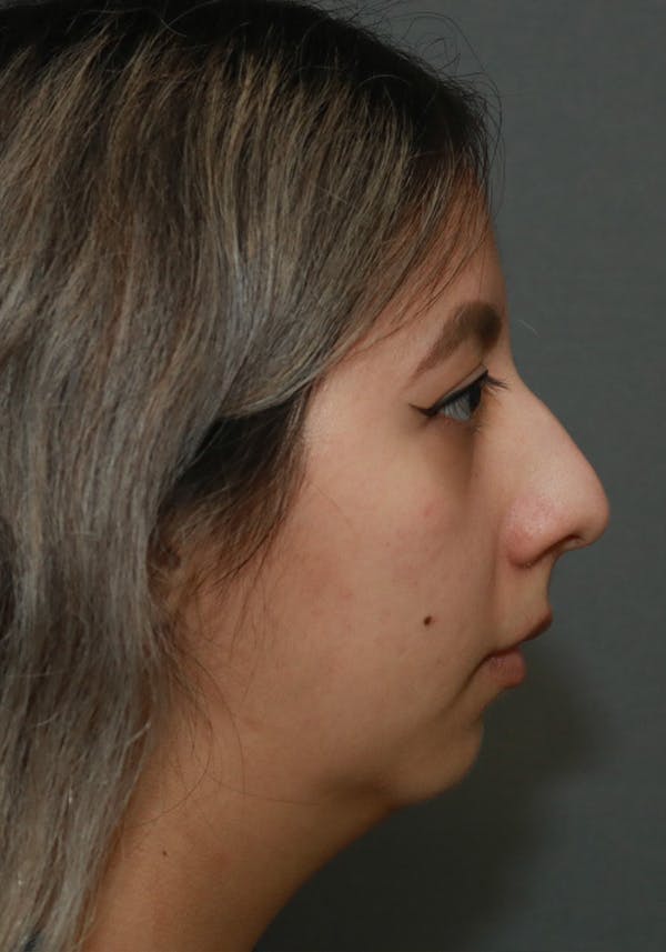 Aesthetic Rhinoplasty Before & After Gallery - Patient 37536322 - Image 5