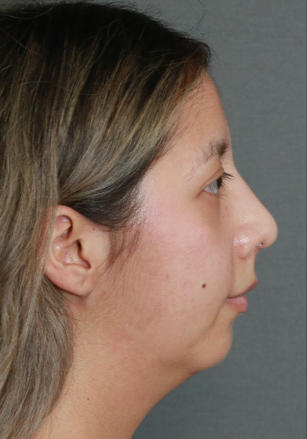 Aesthetic Rhinoplasty Before & After Gallery - Patient 37536322 - Image 6
