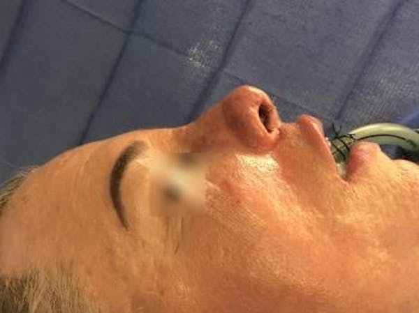 Aesthetic Rhinoplasty Before & After Gallery - Patient 37536343 - Image 2