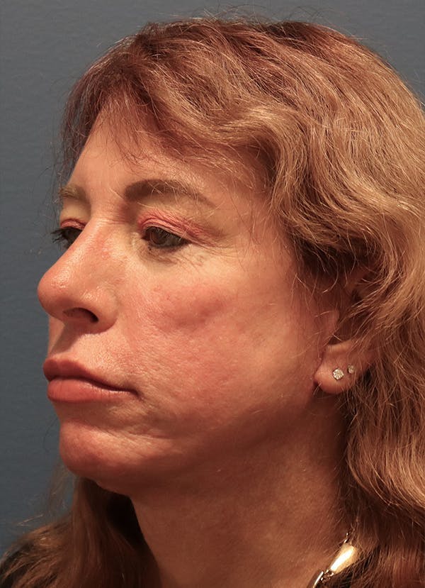 Aesthetic Rhinoplasty Before & After Gallery - Patient 37536344 - Image 4