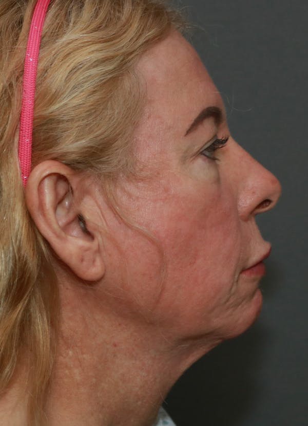 Aesthetic Rhinoplasty Before & After Gallery - Patient 37536344 - Image 5