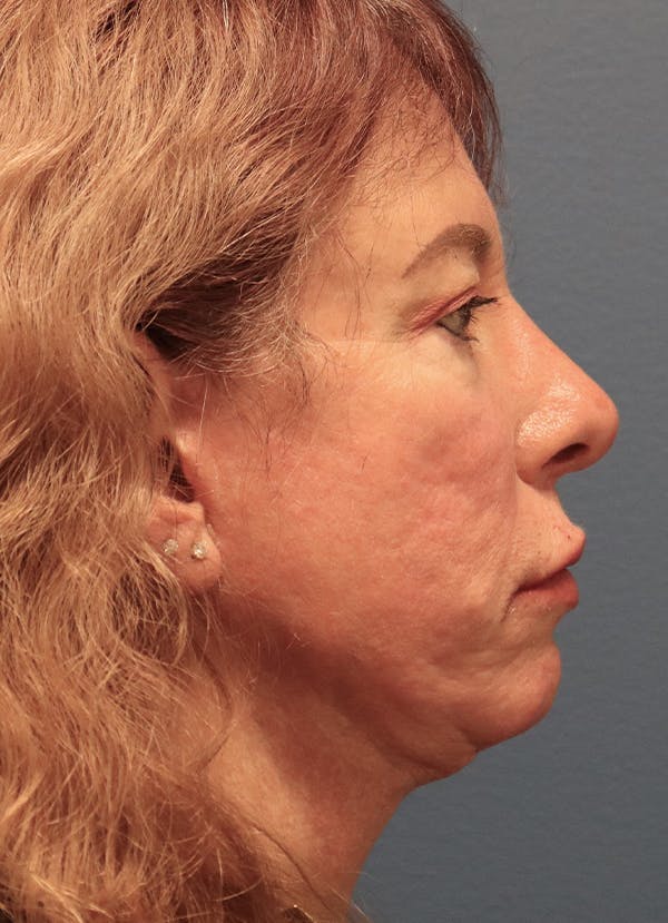 Aesthetic Rhinoplasty Before & After Gallery - Patient 37536344 - Image 6