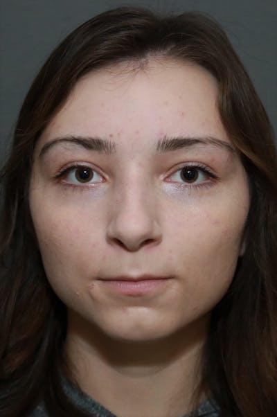 Functional Rhinoplasty Before & After Gallery - Patient 5070449 - Image 1
