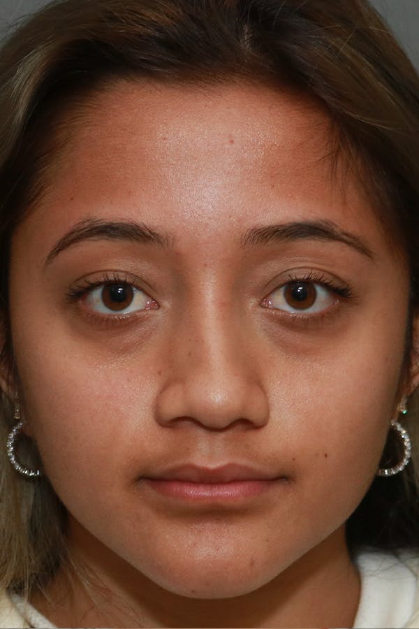 Functional Rhinoplasty Before & After Gallery - Patient 44812284 - Image 1