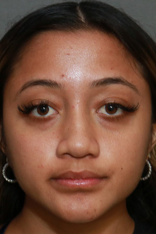 Functional Rhinoplasty Before & After Gallery - Patient 44812284 - Image 2