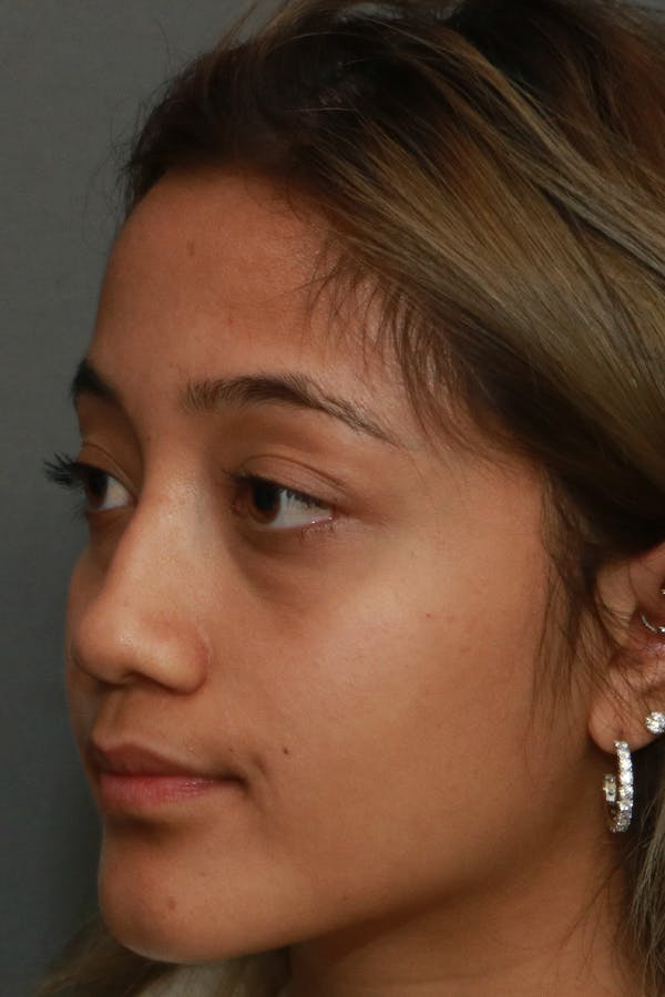 Functional Rhinoplasty Before & After Gallery - Patient 44812284 - Image 3