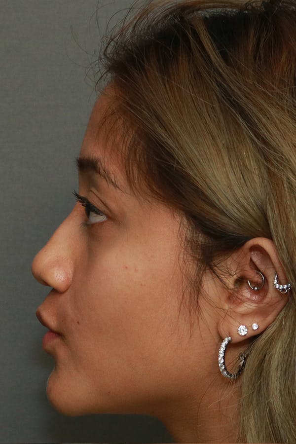 Functional Rhinoplasty Before & After Gallery - Patient 44812284 - Image 5