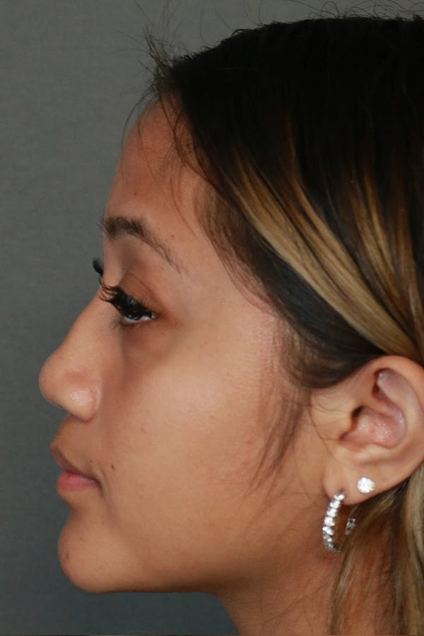 Functional Rhinoplasty Before & After Gallery - Patient 44812284 - Image 6