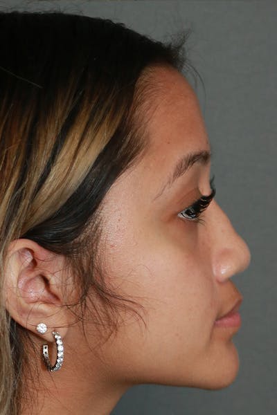 Functional Rhinoplasty Before & After Gallery - Patient 44812284 - Image 10
