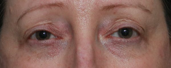 Lower Blepharoplasty Before & After Gallery - Patient 44812288 - Image 1