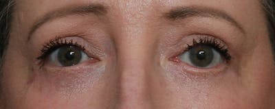Lower Blepharoplasty Before & After Gallery - Patient 44812288 - Image 2