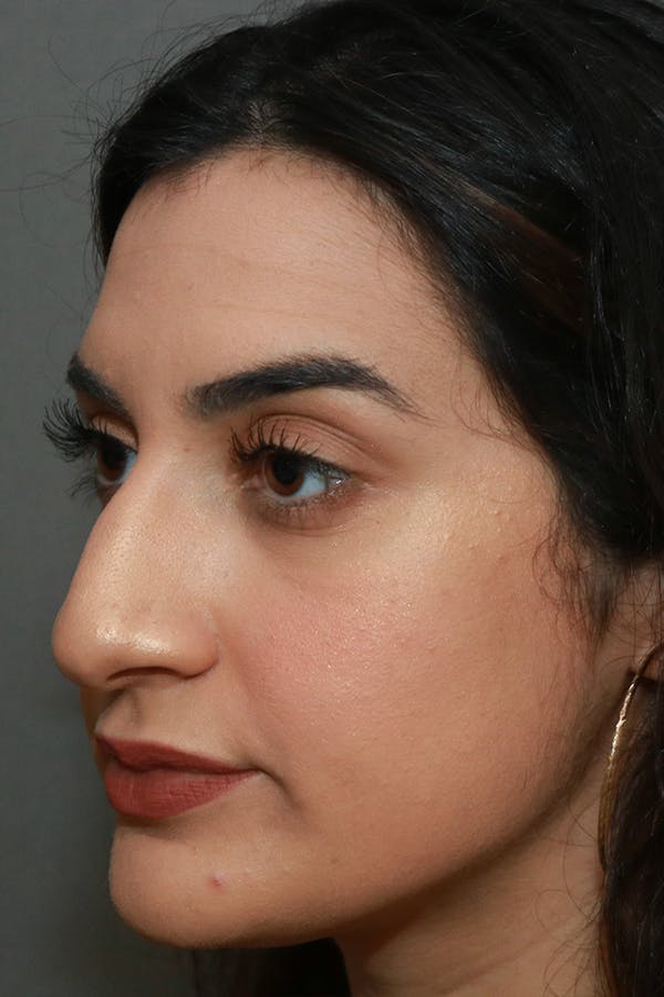Aesthetic Rhinoplasty Before & After Gallery - Patient 44812331 - Image 3