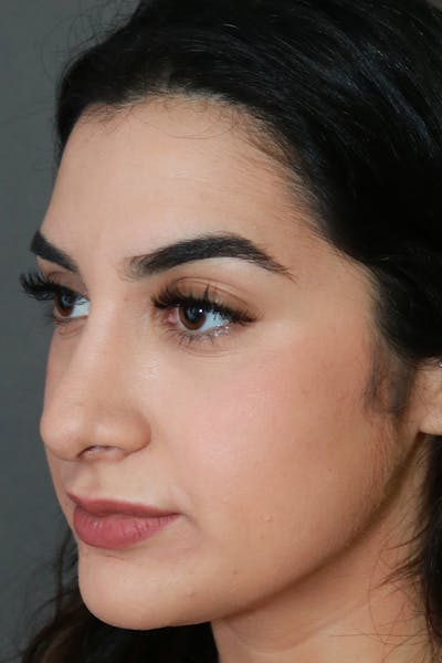 Aesthetic Rhinoplasty Before & After Gallery - Patient 44812331 - Image 4