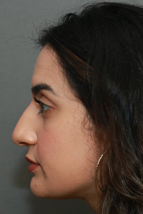 Aesthetic Rhinoplasty Before & After Gallery - Patient 44812331 - Image 5