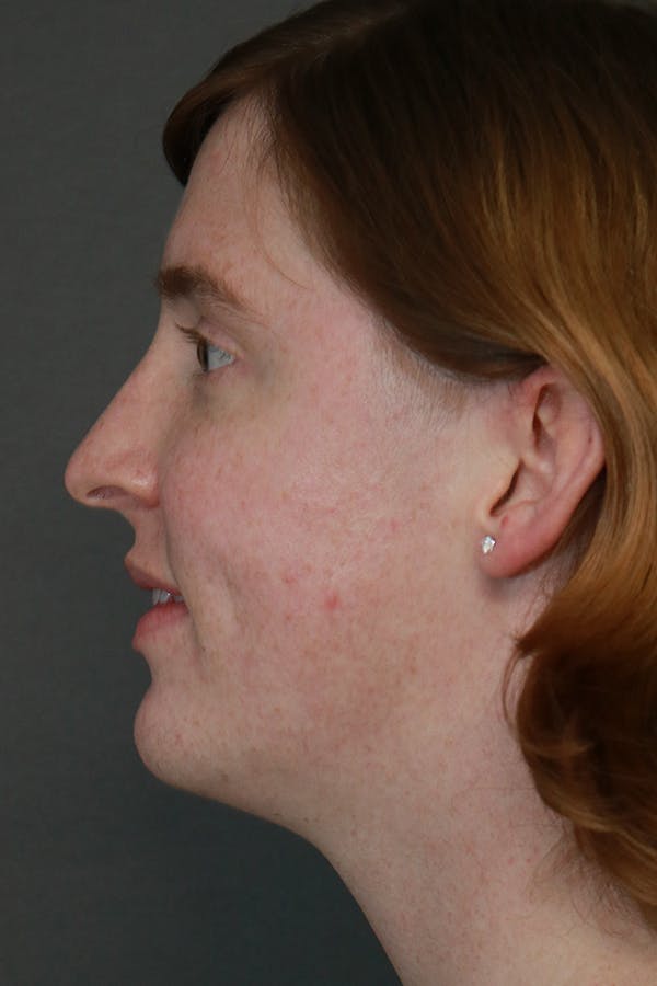 Aesthetic Rhinoplasty Before & After Gallery - Patient 44812330 - Image 5