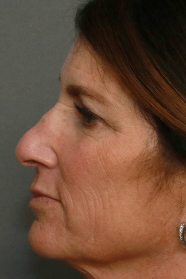 Aesthetic Rhinoplasty Before & After Gallery - Patient 44812333 - Image 5