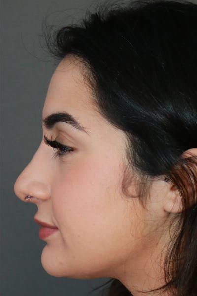 Aesthetic Rhinoplasty Before & After Gallery - Patient 44812330 - Image 6