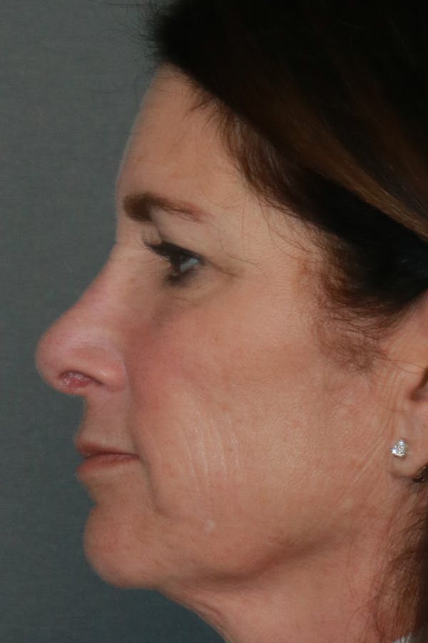 Aesthetic Rhinoplasty Before & After Gallery - Patient 44812333 - Image 6