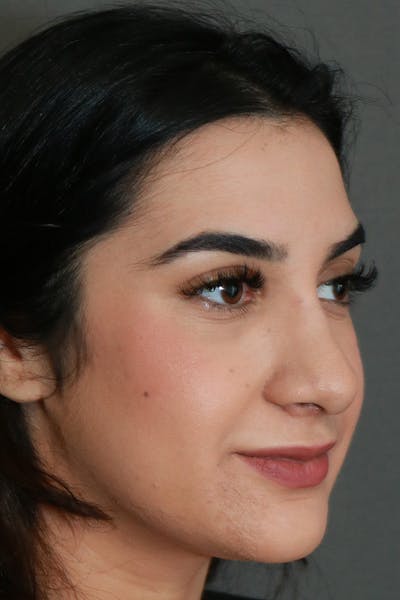 Aesthetic Rhinoplasty Before & After Gallery - Patient 44812331 - Image 8