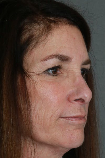 Aesthetic Rhinoplasty Before & After Gallery - Patient 44812333 - Image 8