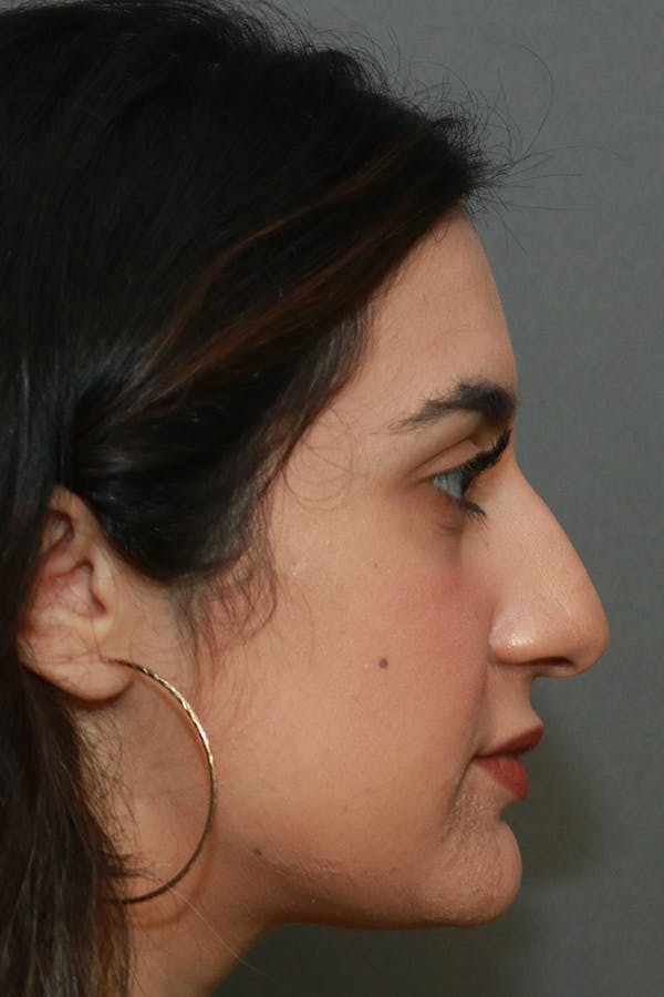 Aesthetic Rhinoplasty Before & After Gallery - Patient 44812330 - Image 9