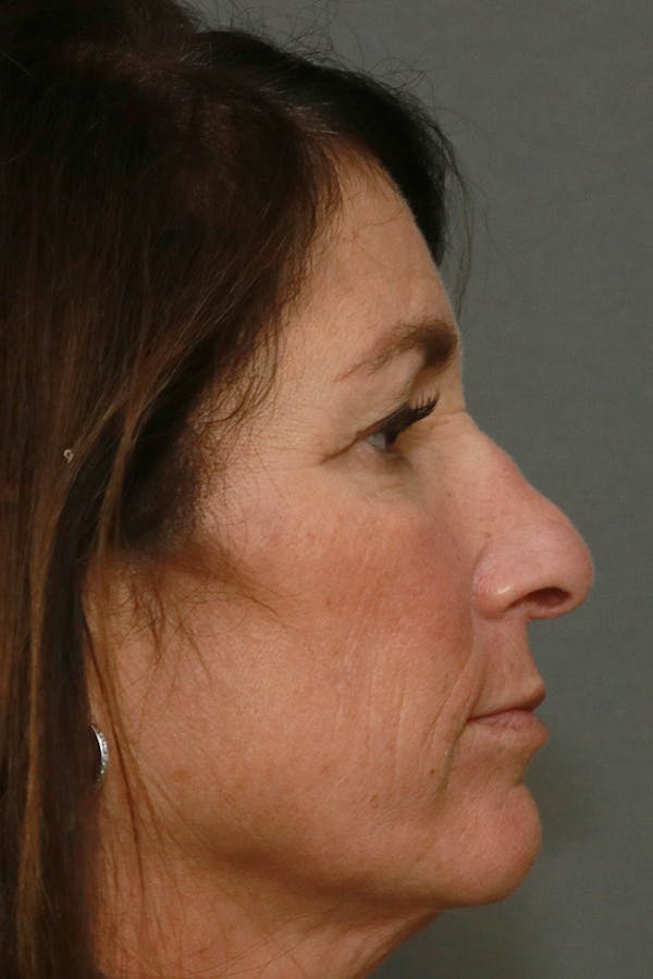 Aesthetic Rhinoplasty Before & After Gallery - Patient 44812333 - Image 9