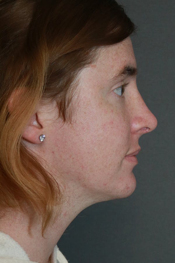 Aesthetic Rhinoplasty Before & After Gallery - Patient 44812330 - Image 10