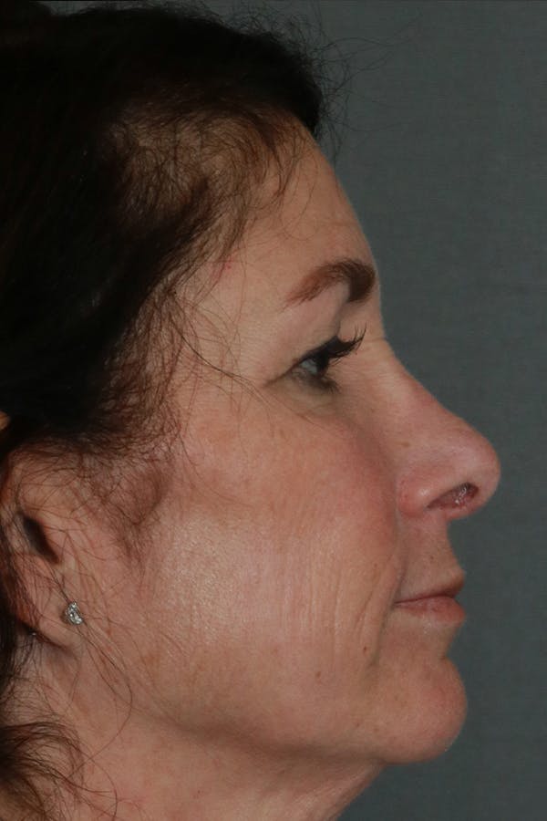 Aesthetic Rhinoplasty Before & After Gallery - Patient 44812333 - Image 10