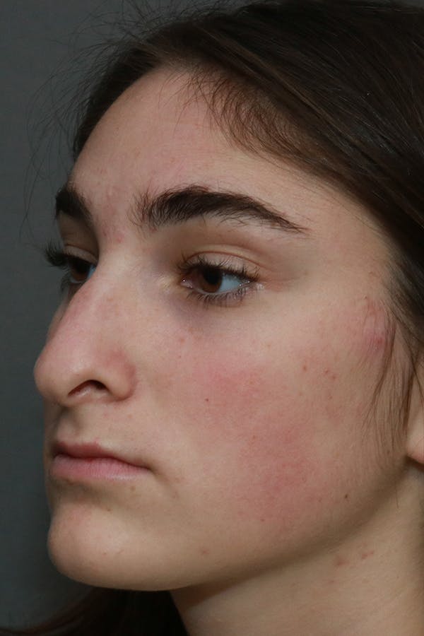 Aesthetic Rhinoplasty Before & After Gallery - Patient 44812332 - Image 3