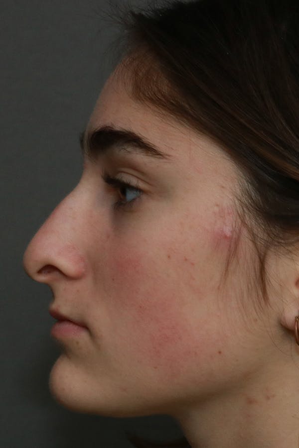 Aesthetic Rhinoplasty Before & After Gallery - Patient 44812332 - Image 5