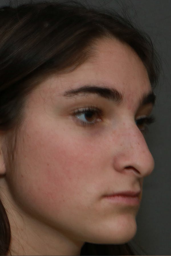 Aesthetic Rhinoplasty Before & After Gallery - Patient 44812332 - Image 7