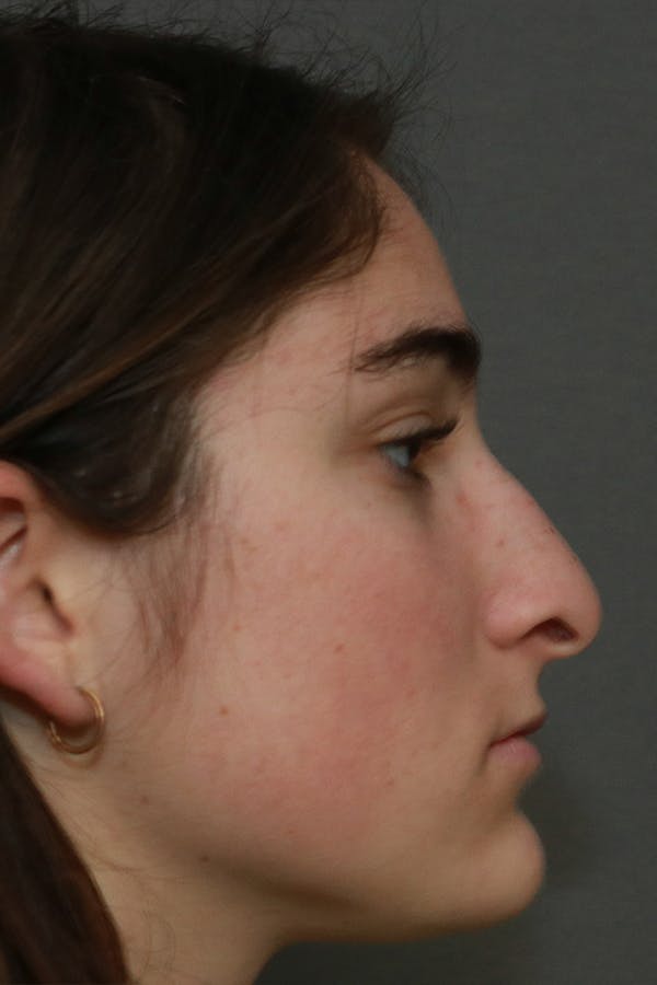 Aesthetic Rhinoplasty Before & After Gallery - Patient 44812332 - Image 9