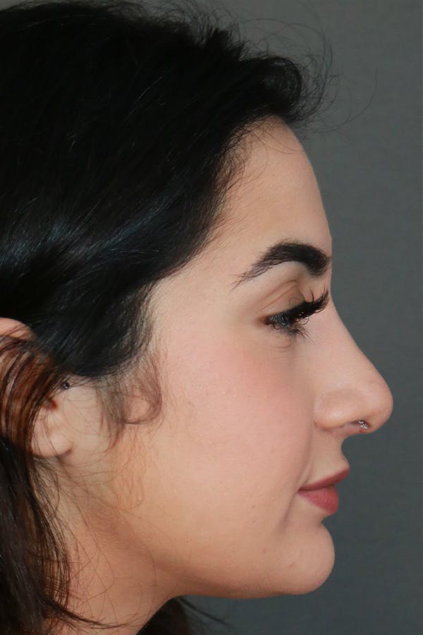 Aesthetic Rhinoplasty Before & After Gallery - Patient 44812331 - Image 10