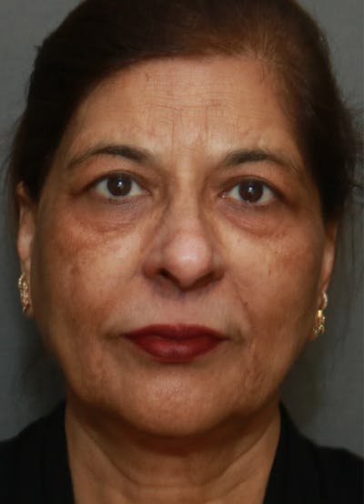 Facelift Before & After Gallery - Patient 48085513 - Image 1