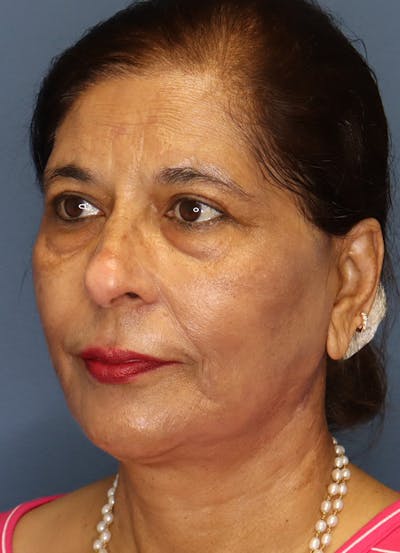 Facelift Before & After Gallery - Patient 48085513 - Image 4