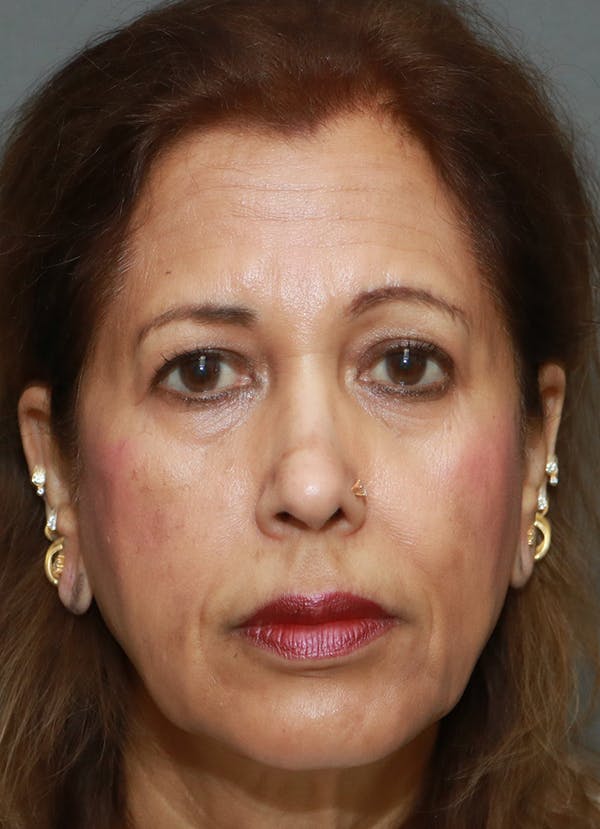 Facelift Before & After Gallery - Patient 48085514 - Image 1