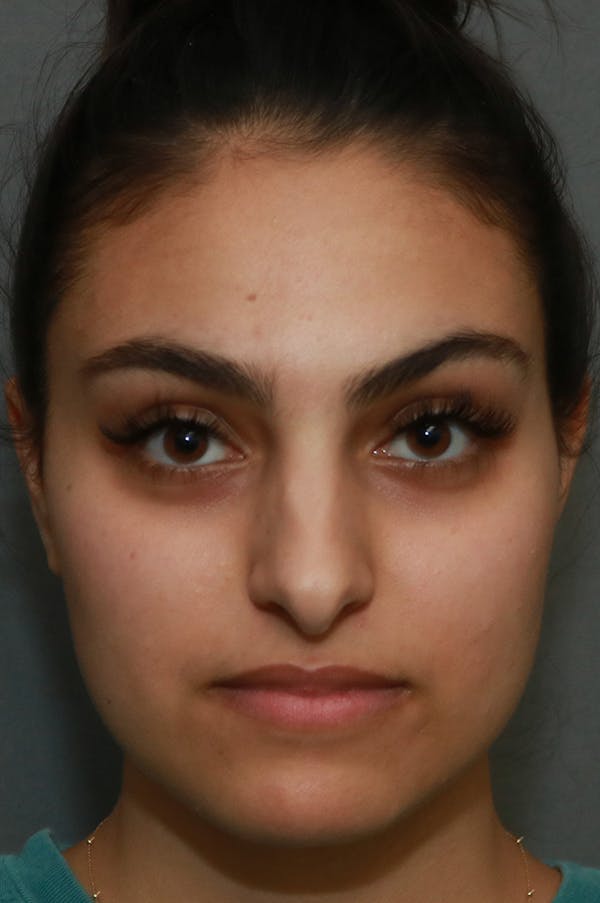 Aesthetic Rhinoplasty Before & After Gallery - Patient 48085874 - Image 1