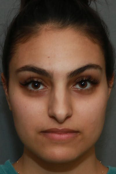 Aesthetic Rhinoplasty Before & After Gallery - Patient 48085874 - Image 1