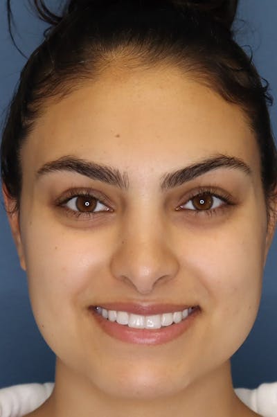 Aesthetic Rhinoplasty Before & After Gallery - Patient 48085874 - Image 2