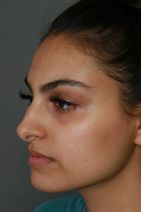Aesthetic Rhinoplasty Before & After Gallery - Patient 48085874 - Image 3