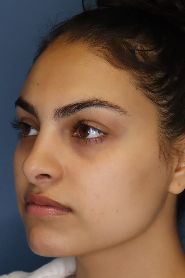 Aesthetic Rhinoplasty Before & After Gallery - Patient 48085874 - Image 4