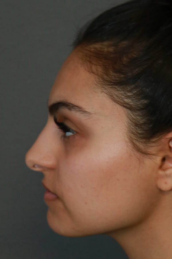 Aesthetic Rhinoplasty Before & After Gallery - Patient 48085874 - Image 5