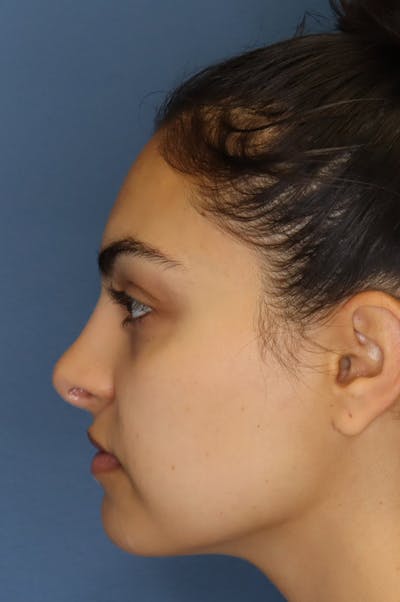 Aesthetic Rhinoplasty Before & After Gallery - Patient 48085874 - Image 6