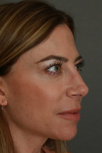 Aesthetic Rhinoplasty Before & After Gallery - Patient 48085875 - Image 1