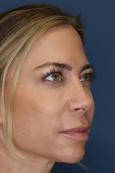 Aesthetic Rhinoplasty Before & After Gallery - Patient 48085875 - Image 2