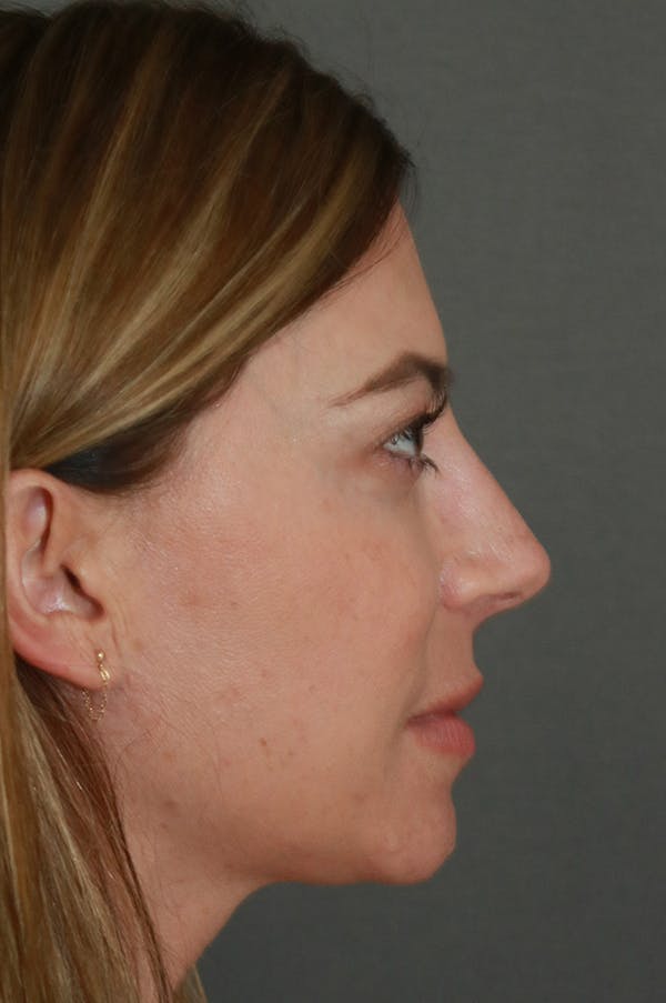 Aesthetic Rhinoplasty Before & After Gallery - Patient 48085875 - Image 3