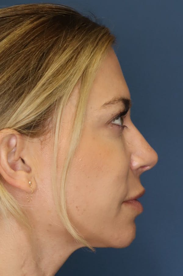 Aesthetic Rhinoplasty Before & After Gallery - Patient 48085875 - Image 4