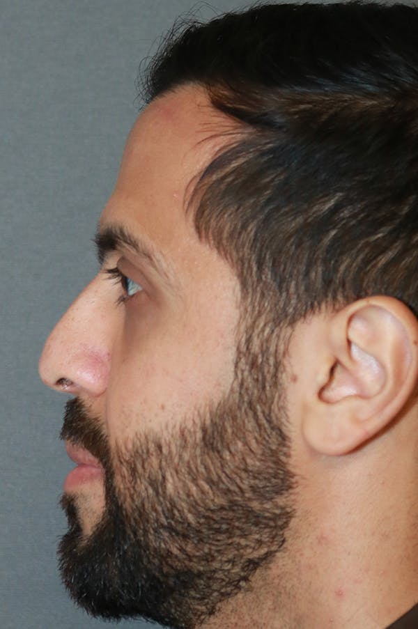 Aesthetic Rhinoplasty Before & After Gallery - Patient 48085876 - Image 3