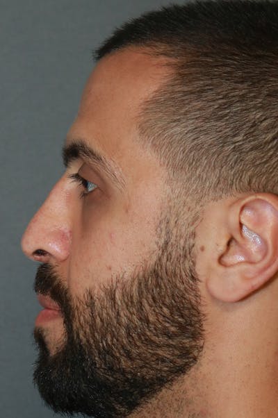 Aesthetic Rhinoplasty Before & After Gallery - Patient 48085876 - Image 4